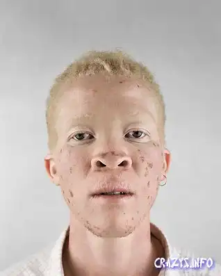 Негры-альбиносы