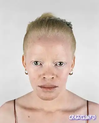 Негры-альбиносы