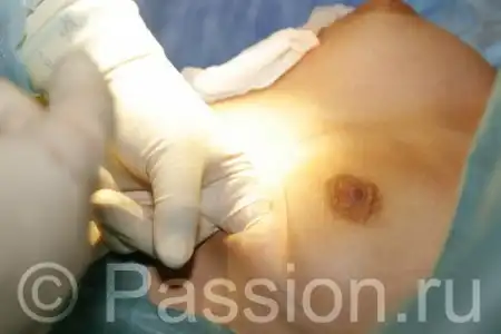 Операция по увеличению груди. От и до. (не для слабонервных фото)