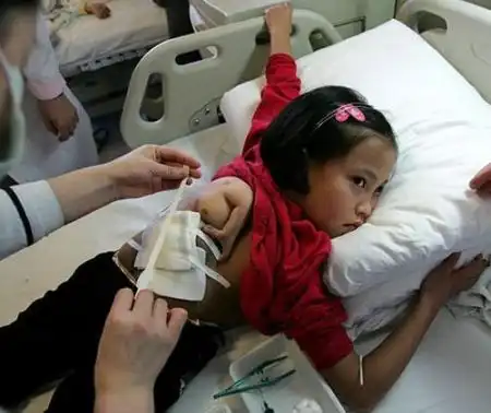 В Китае прооперировали девочку, у которой три руки