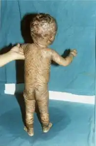 Ихтиоз Ихтиоз