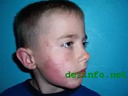 Что ядовитый плющ может сделать с человеком