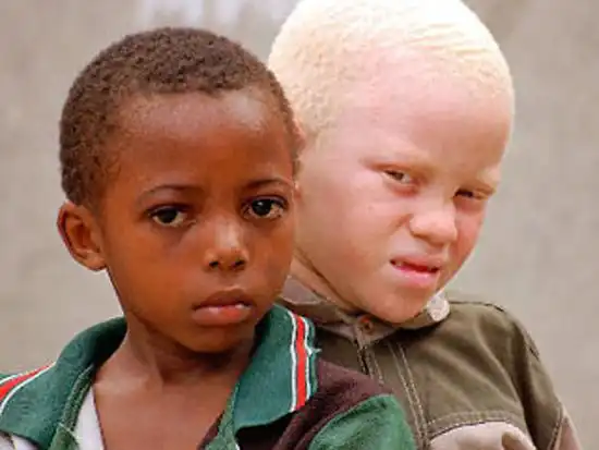 Бескровные люди- альбиносы