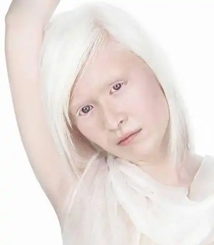 Бескровные люди- альбиносы