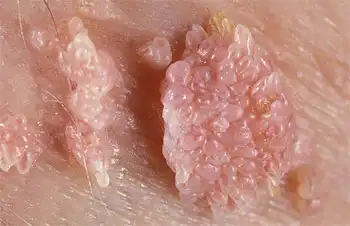 Всем аппетитных кожных заболеваний :3