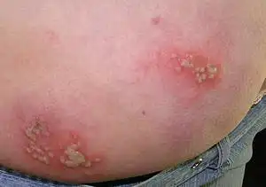 Всем аппетитных кожных заболеваний :3