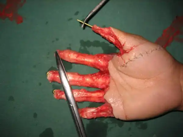 Скальпированная рана руки.