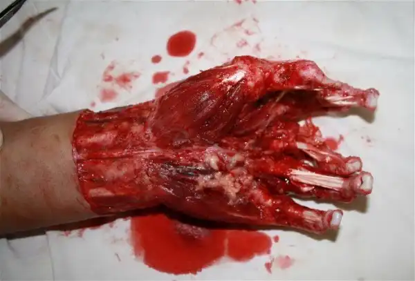 Скальпированная рана руки.