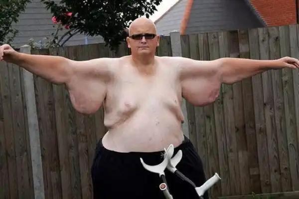 Самый толстый мужчина планеты похудел на 292 килограмма