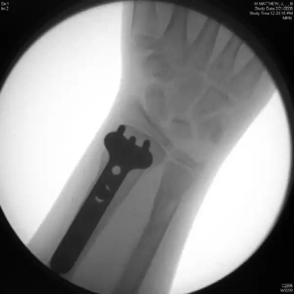 Жесть: Восстановление руки после падения с горнолыжного подъемника