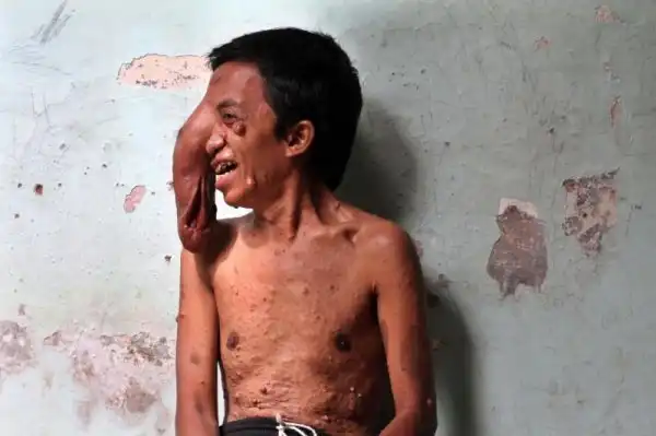 Индонезиец страдает от постоянно растущей опухоли на месте глаза