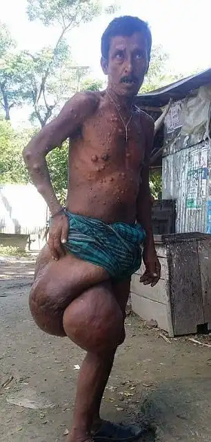 Мужчина из Бангладеш не ходит уже 40 лет из-за огромной опухоли