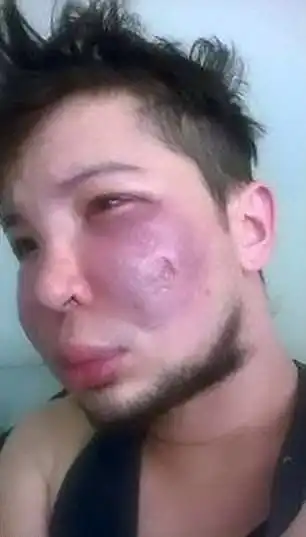 Лицо колумбийского модника после неудачной операции по увеличению щек
