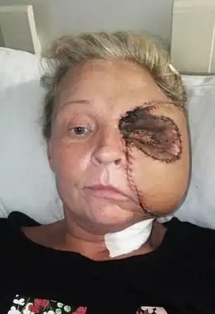 Из-за царапины над бровью женщина потеряла половину лица