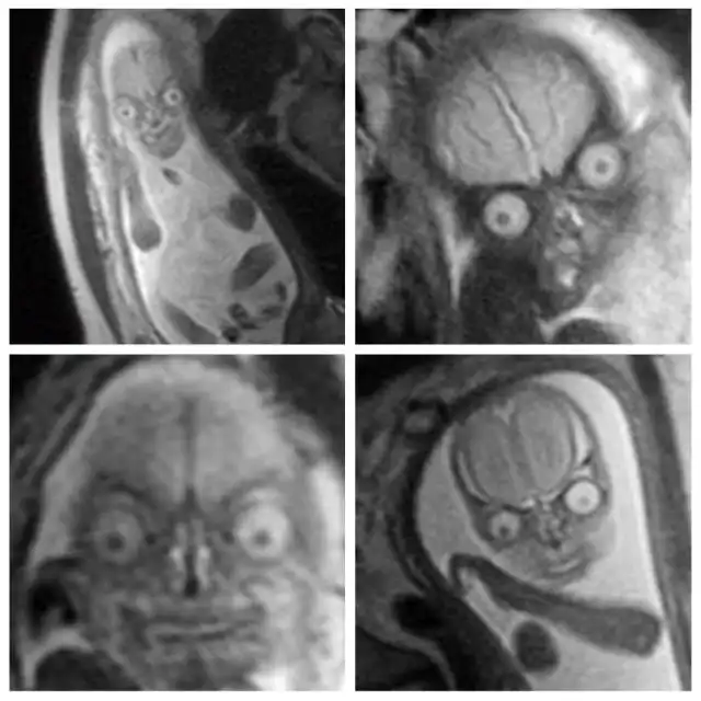 "Поздравляем, у вас демон": жуткий МРТ-снимок беременной женщины