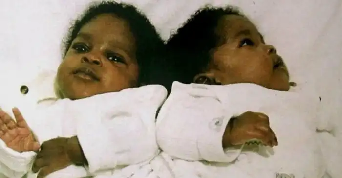 Неразлучные разлучились: как сиамские близняшки удивили мир