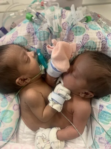 У молодой пары родились сиамские близнецы - и они решили их разделить несмотря на страх потерять обоих