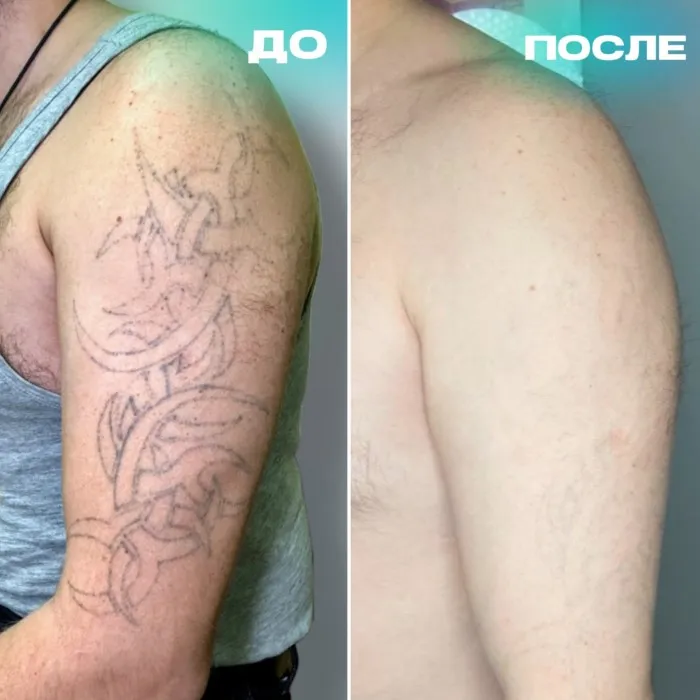 Татуировки удаляет не лазер Татуировки удаляет не лазер